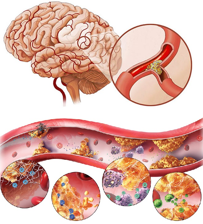 Лечение атеросклероза клиники. Атеросклероз артерий головного мозга. Атеросклероз бляшки сосудов. Атеросклероз сосудов головного мозга симптомы. Атеросклероз церебральных сосудов симптомы.