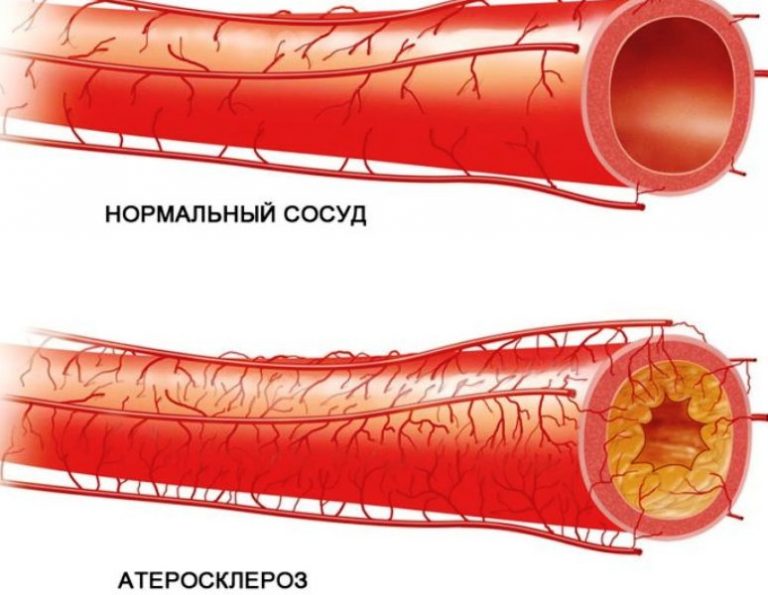 Сосуды забитые холестерином фото